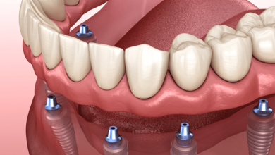Cost of Full Mouth Dental Implants